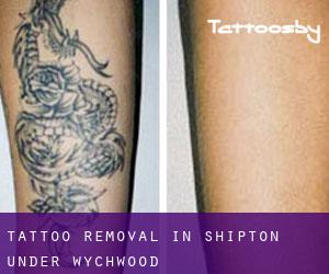Tattoo Removal in Shipton under Wychwood