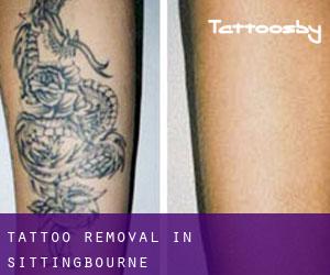 Tattoo Removal in Sittingbourne