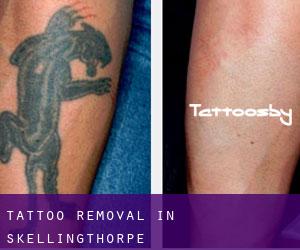 Tattoo Removal in Skellingthorpe