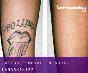 Tattoo Removal in South Lanarkshire