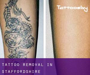 Tattoo Removal in Staffordshire