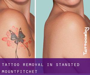Tattoo Removal in Stansted Mountfitchet
