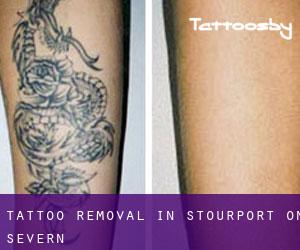Tattoo Removal in Stourport On Severn