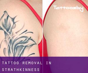 Tattoo Removal in Strathkinness