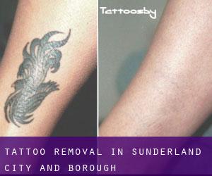 Tattoo Removal in Sunderland (City and Borough)