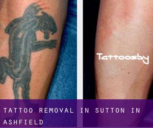 Tattoo Removal in Sutton in Ashfield