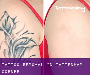 Tattoo Removal in Tattenham Corner