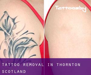 Tattoo Removal in Thornton (Scotland)