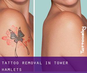 Tattoo Removal in Tower Hamlets