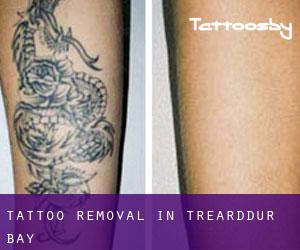 Tattoo Removal in Trearddur Bay