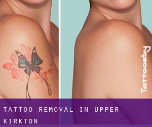 Tattoo Removal in Upper Kirkton