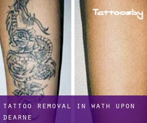 Tattoo Removal in Wath upon Dearne