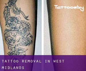 Tattoo Removal in West Midlands