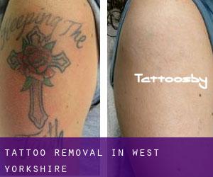 Tattoo Removal in West Yorkshire