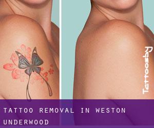 Tattoo Removal in Weston Underwood