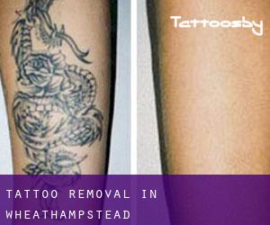 Tattoo Removal in Wheathampstead