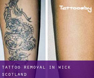 Tattoo Removal in Wick (Scotland)
