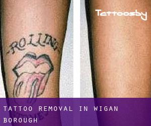 Tattoo Removal in Wigan (Borough)