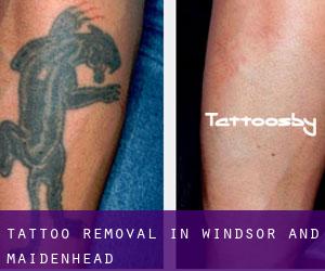Tattoo Removal in Windsor and Maidenhead