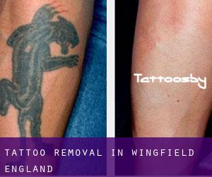 Tattoo Removal in Wingfield (England)