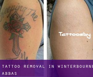 Tattoo Removal in Winterbourne Abbas